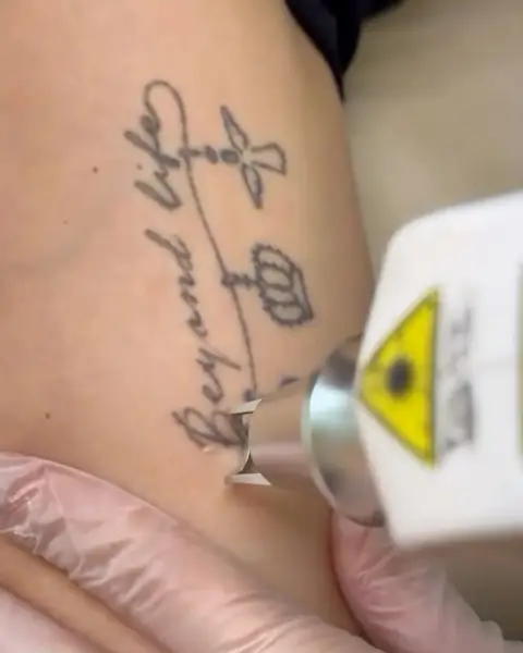 Ponteira do Ômer sobre uma tatuagem escrita no braço, durante a sessão de remoção