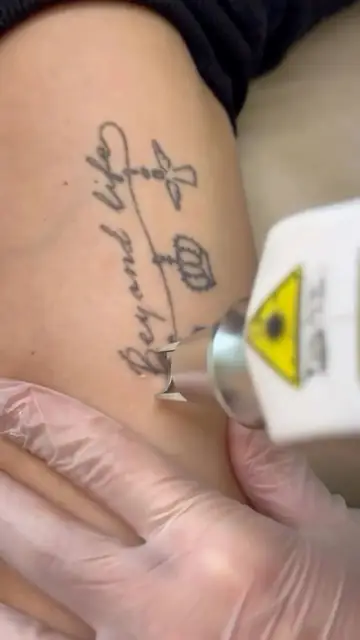 Sessão de remoção de tatuagem no braço com a ponteira do Ômer