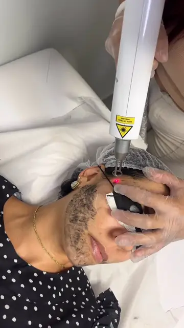Cliente deitado com a máscara de carvão do Black Peel e a ponteira do laser sobre o rosto